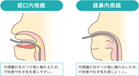 endoscopy_point_img1